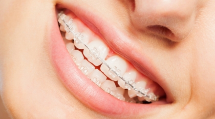 person with braces for malocclusion